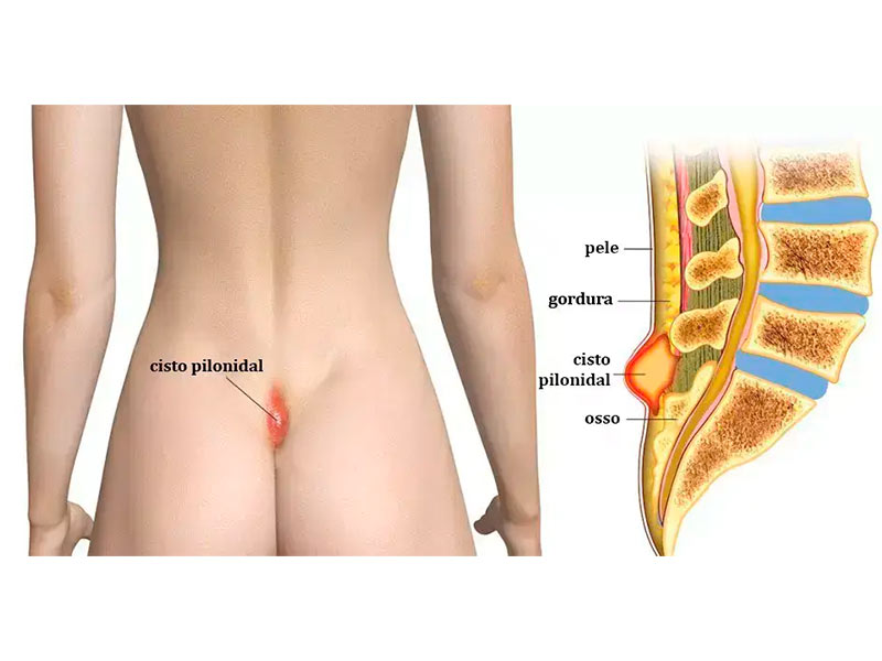 cisto pilonidal