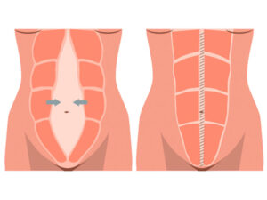 diástase abdominal