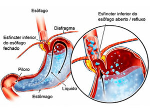 doença do refluxo gastroesofagico
