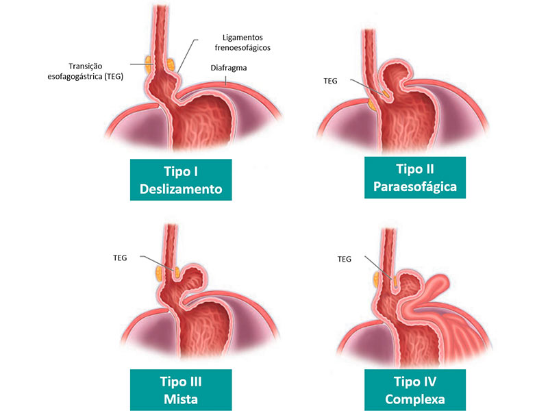 doença do refluxo gastroesofagico