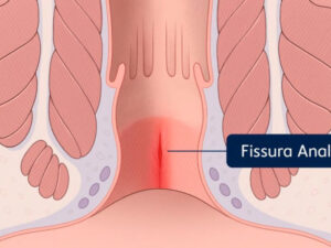 fissura anal