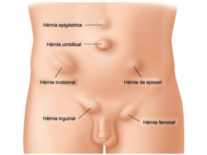 hérnias da parede abdominal