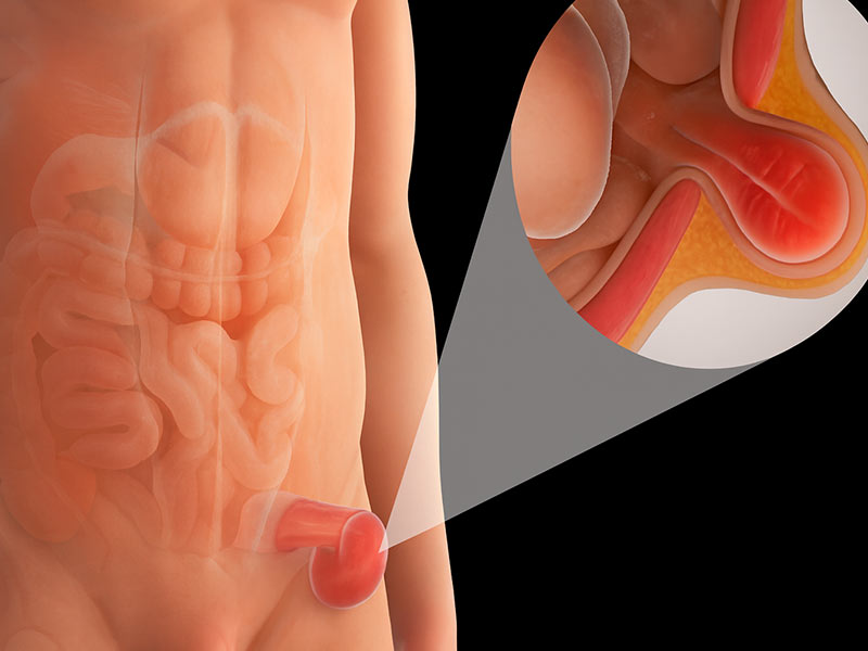 hérnias da parede abdominal