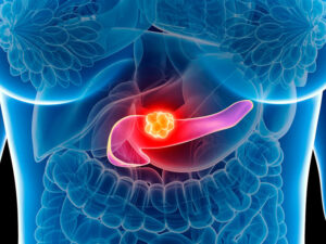 tumor de pâncreas