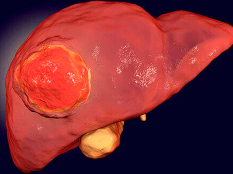 tumor hepático