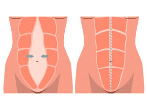 diástase abdominal