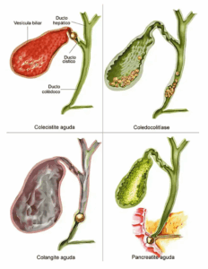 Doenças da Vesícula Biliar