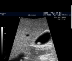 Doenças da Vesícula Biliar