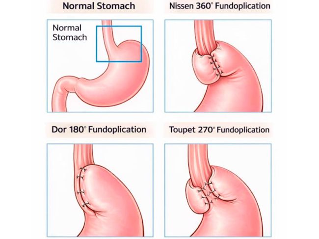 Doença do refluxo gastroesofágico (DRGE)